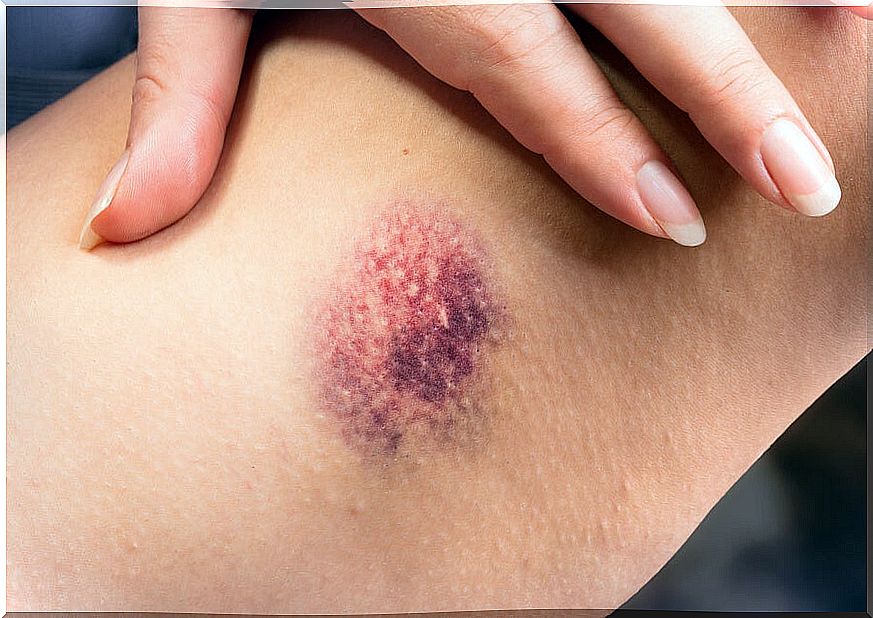 10 home remedies against bruises