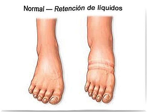 Fluid retention