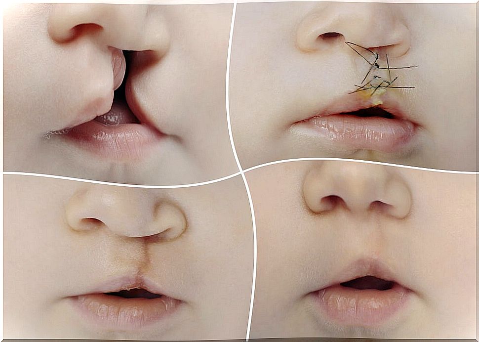 Child with cleft lip and reconstruction surgery.