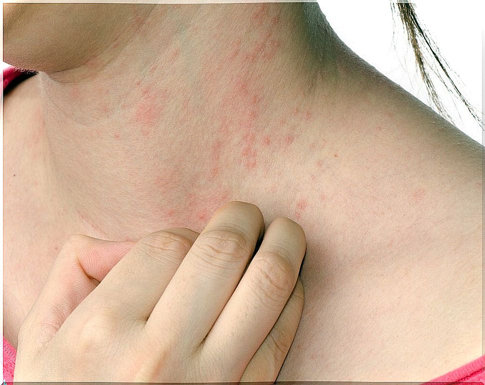 Eczema and stress are related.