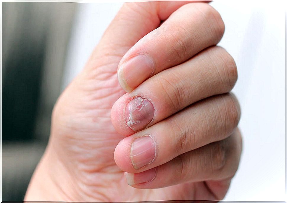 Having nail fungus: everything you need to know