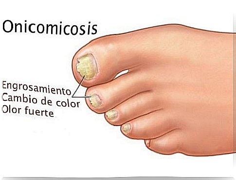 Nail fungus or onychomycosis