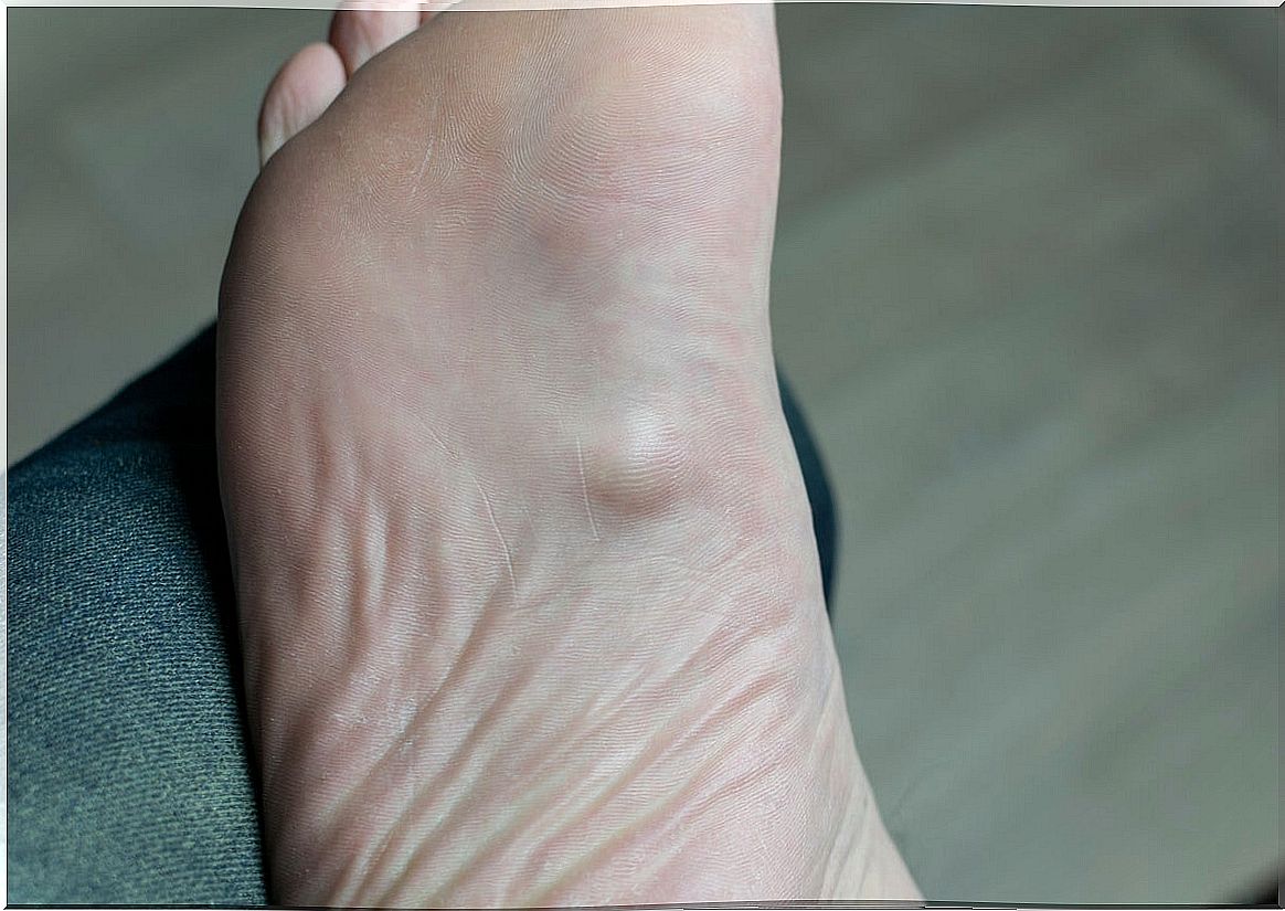 Pain in the sole of the foot.