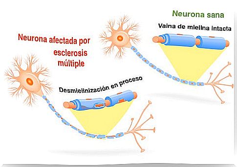 Neuron with multiple sclerosis and healthy neuron