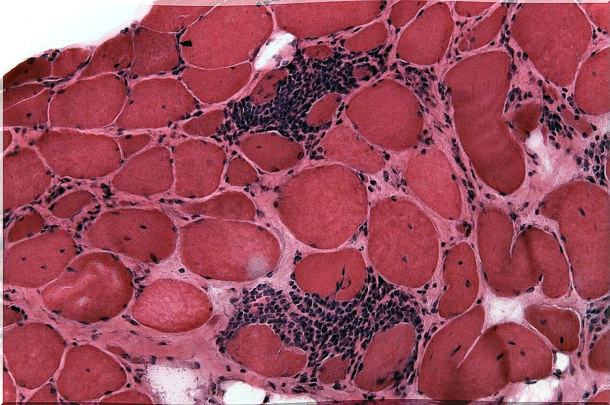 Polymyositis pathophysiology