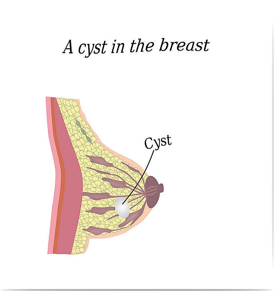 Breast cysts are usually benign.