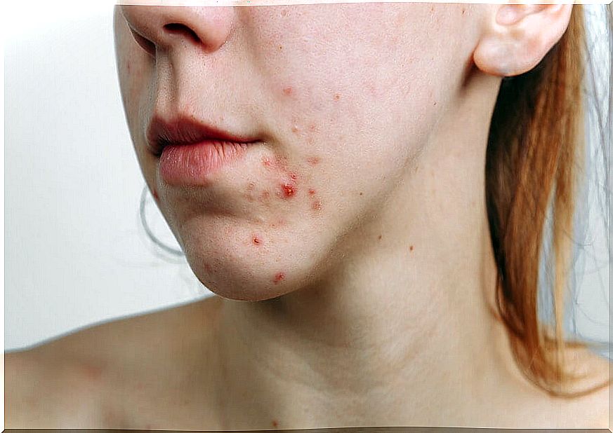 Acne appears if you are not in good health