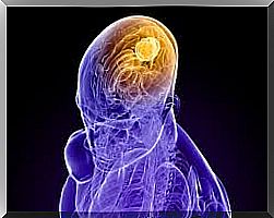 central nerve tumor