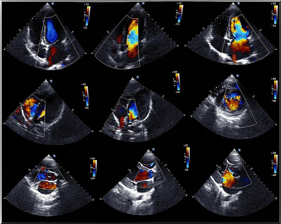 Echocardiogram for pericardial effusion